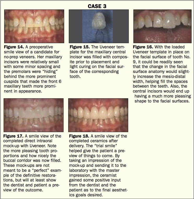 Uveneer Case Study #3. Featured in Dentistry Today